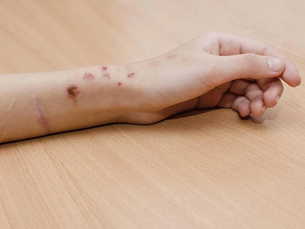 Young lady has scabs on her wrist due to self harm.