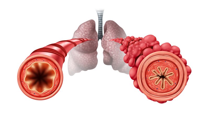 Bronchial tubes may become obstructed due to vaping.