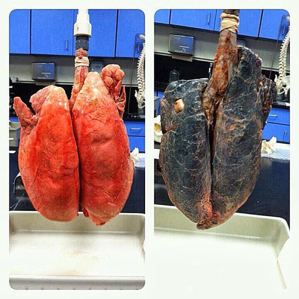 A comparison of healthy lungs vs. smokers lungs.